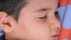 Artikelgebend sind Behandlungsmöglichkeiten der Nesselsucht bei Kindern.
