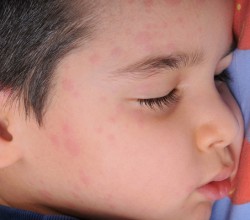 Artikelgebend sind Behandlungsmöglichkeiten der Nesselsucht bei Kindern.