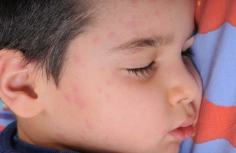 Artikelgebend sind Behandlungsmöglichkeiten der Nesselsucht bei Kindern.